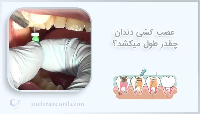 عصب کشی دندان چقدر طول میکشد