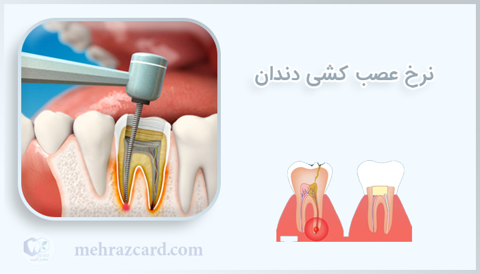 نرخ عصب کشی دندان
