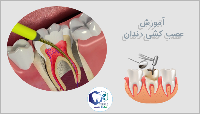 آموزش عصب کشی دندان