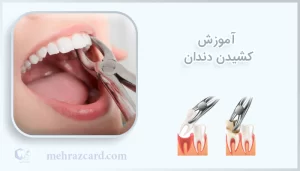 آموزش کشیدن دندان