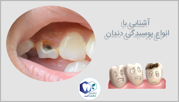انواع پوسیدگی دندان