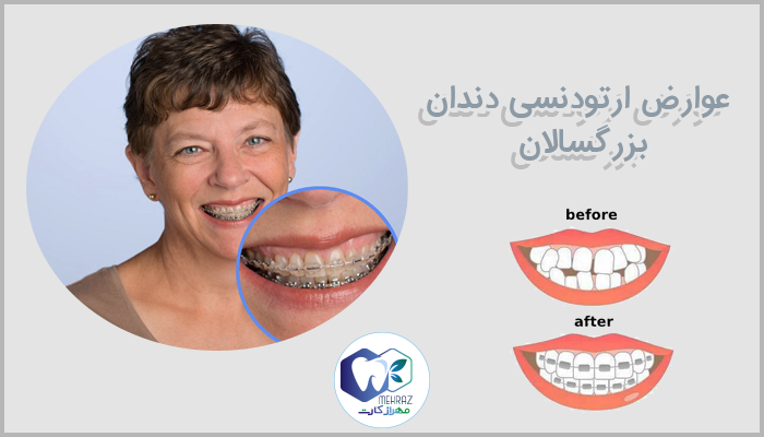 عوارض ارتودنسی دندان بزرگسالان
