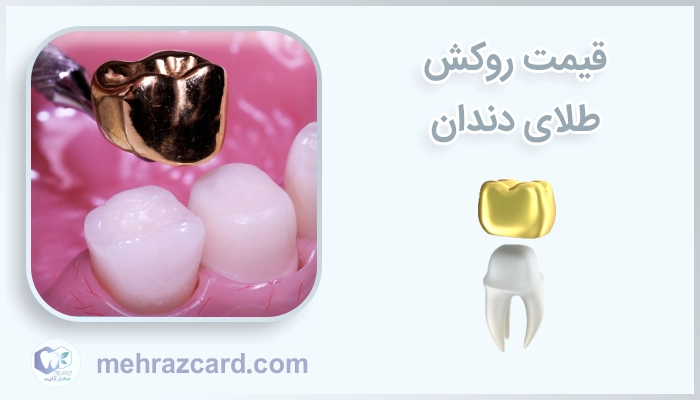 قیمت روکش طلای دندان