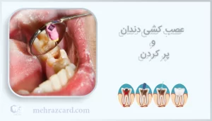 عصب کشی دندان و پر کردن