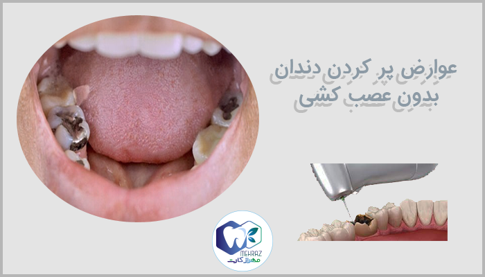 عوارض پر کردن دندان بدون عصب کشی