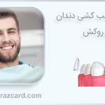 هزینه عصب کشی دندان و روکش