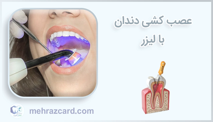 عصب کشی دندان با لیزر