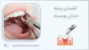 کشیدن ریشه دندان پوسیده