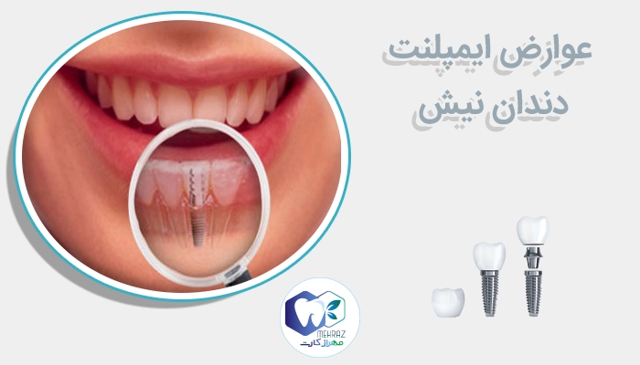 عوارض ایمپلنت دندان نیش