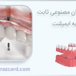 قیمت دندان مصنوعی ثابت بر پایه ایمپلنت