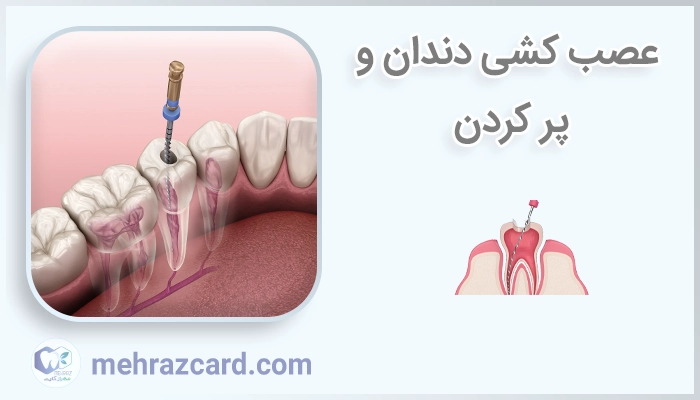 عصب کشی دندان و پر کردن
