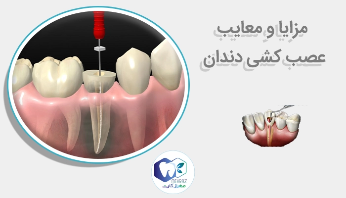 مزایا و معایب عصب کشی دندان