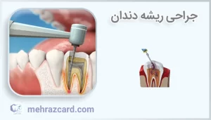 جراحی ریشه دندان
