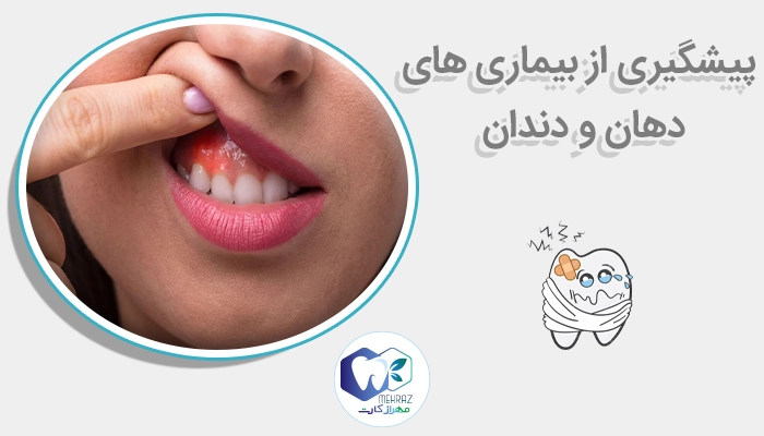 پیشگیری از بیماری های دهان و دندان