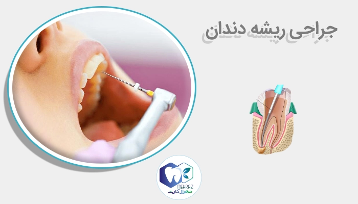 جراحی ریشه دندان