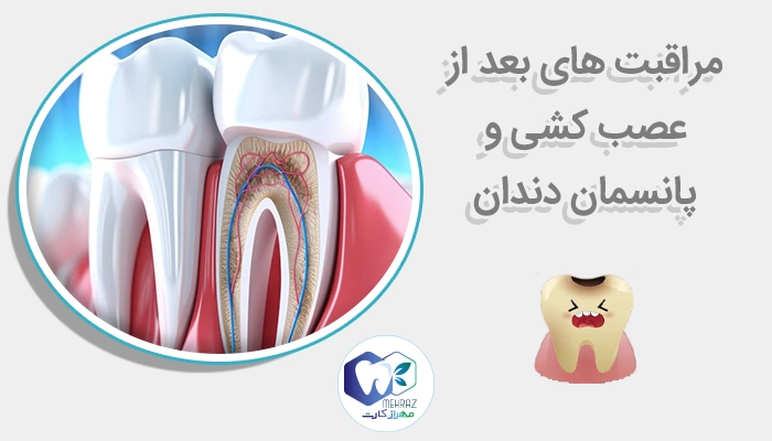 مراقبت های بعد از عصب کشی و پانسمان دندان