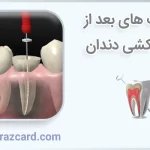 مراقبت های بعد از عصب کشی دندان