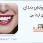 انواع روکش دندان برای زیبایی