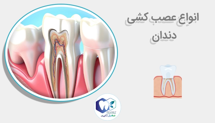 انواع عصب کشی دندان