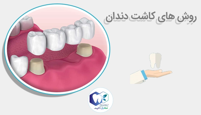 روش های کاشت دندان