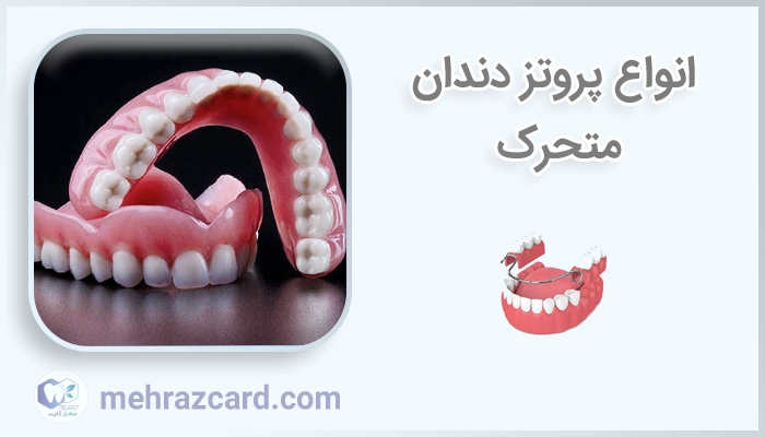 انواع پروتز دندان متحرک