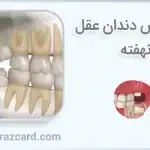 تشخیص دندان عقل نهفته