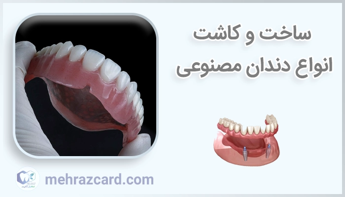 ساخت و کاشت انواع دندان مصنوعی