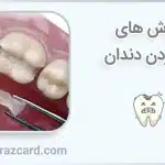 روش های پر کردن دندان