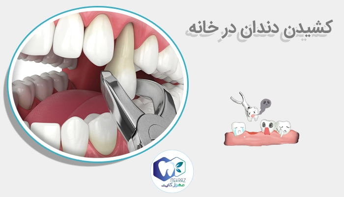 کشیدن دندان در خانه