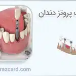 مشکلات پروتز دندان