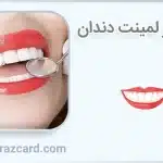 طول عمر لمینت دندان