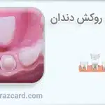 مشکلات روکش دندان