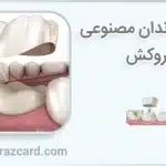 تفاوت دندان مصنوعی و روکش