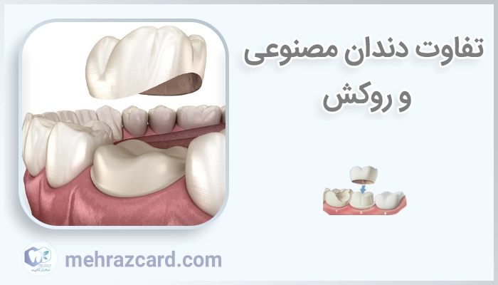 تفاوت دندان مصنوعی و روکش