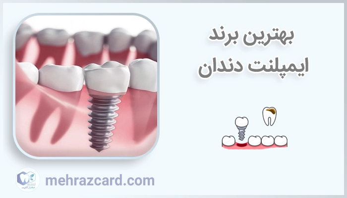 بهترین برند ایمپلنت دندان