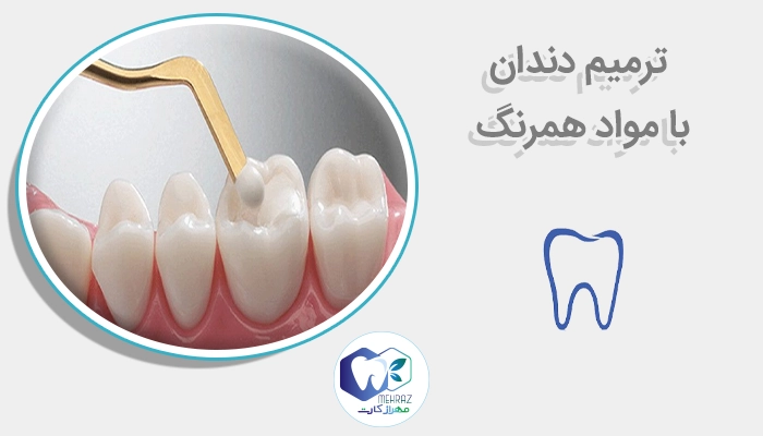 ترمیم دندان با مواد همرنگ