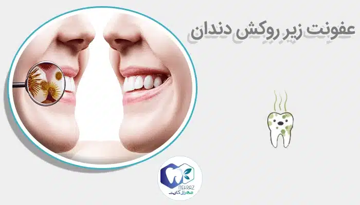 عفونت زیر روکش دندان