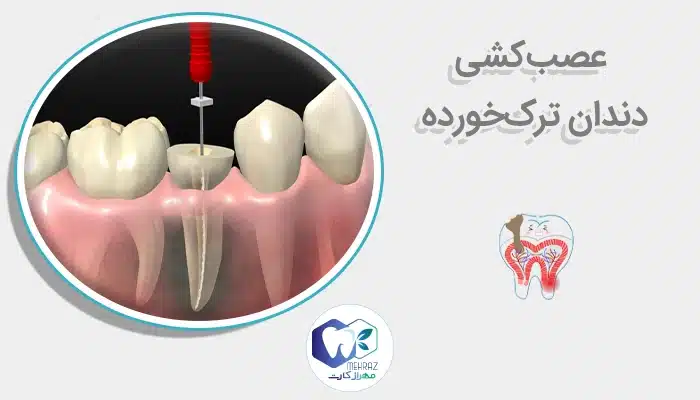 عصب‌کشی دندان ترک‌خورده