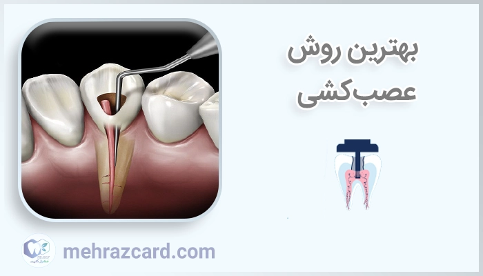 بهترین روش عصب‌کشی