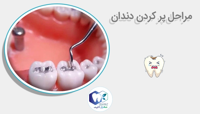 مراحل پر کردن دندان