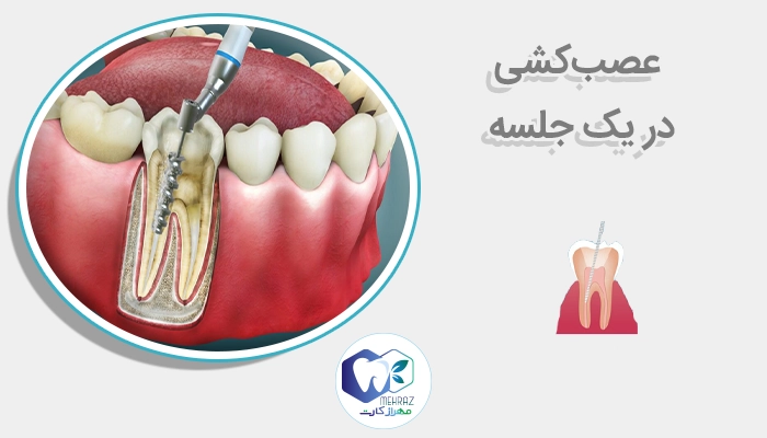 عصب‌کشی در یک جلسه