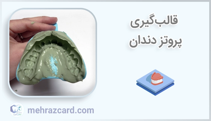 قالب‌گیری پروتز دندان