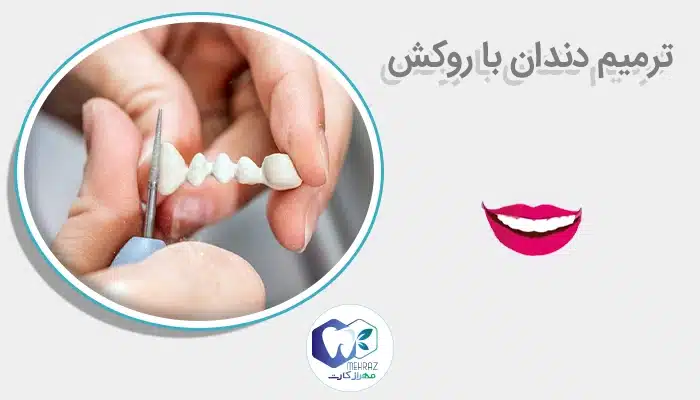 ترمیم دندان با روکش