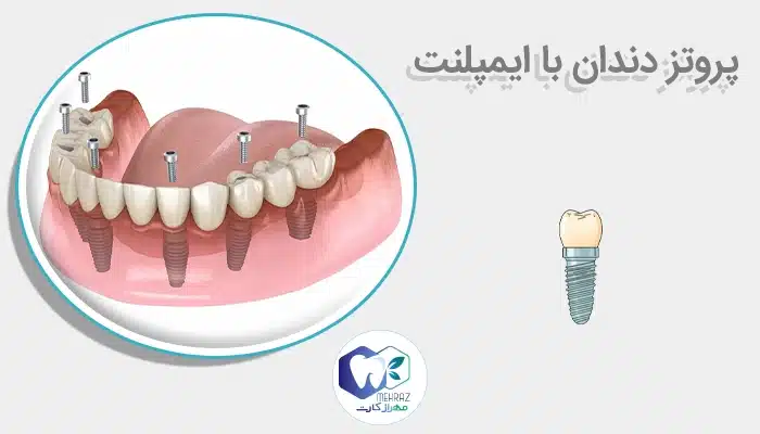 پروتز دندان با ایمپلنت