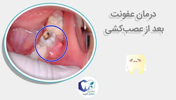 درمان عفونت بعد از عصب‌کشی