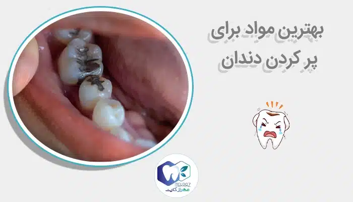 بهترین مواد برای پر کردن دندان