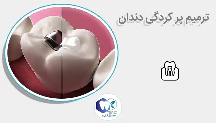 ترمیم پر کردگی دندان