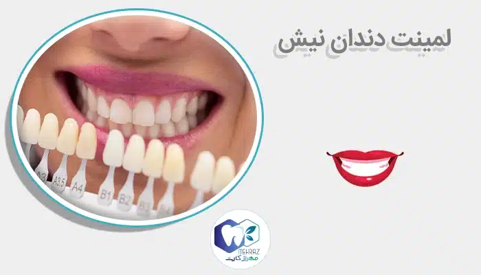 لمینت دندان نیش