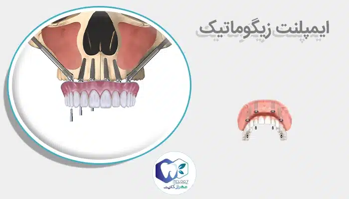 ایمپلنت زیگوماتیک