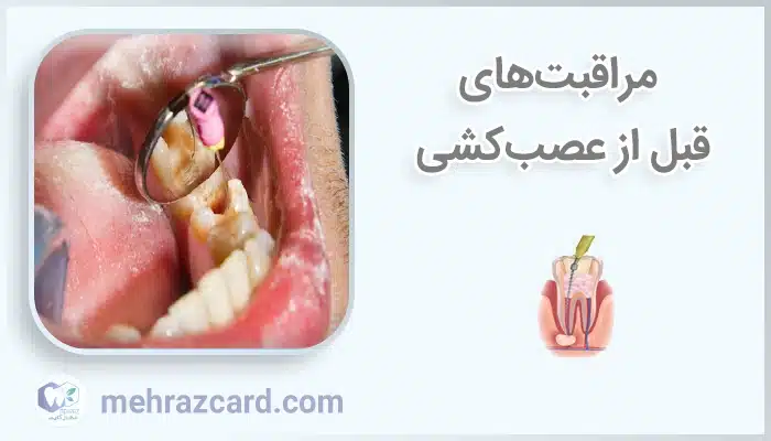 مراقبت‌های قبل از عصب‌کشی